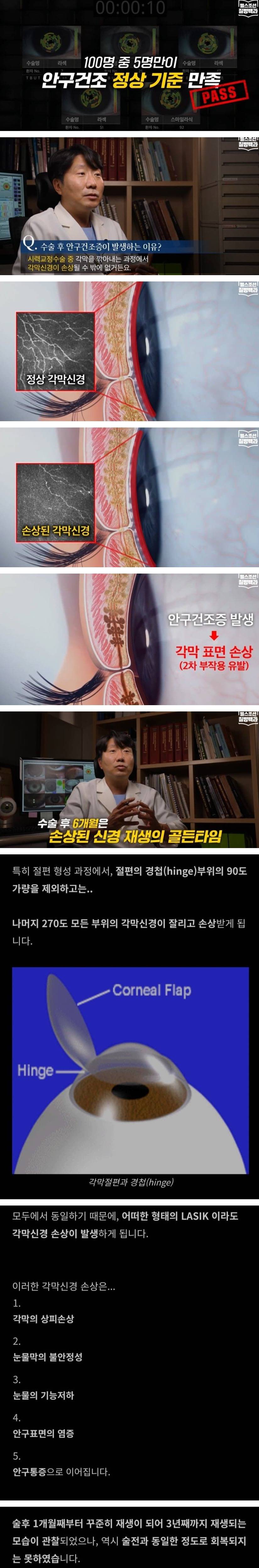 라식 라섹하면 안구건조증 생기는 이유